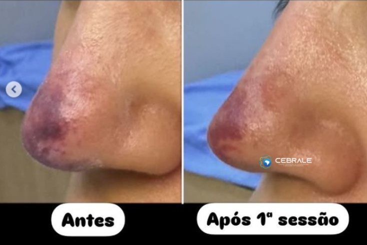 isquemia após o uso de ácido hialurônico